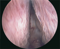 Immagine endoscopica di adenoma prostatico