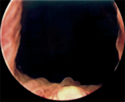 Immagine endoscopica dopo vaporesezione Laser