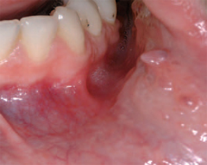 Pseudofibromi orali - foto 4