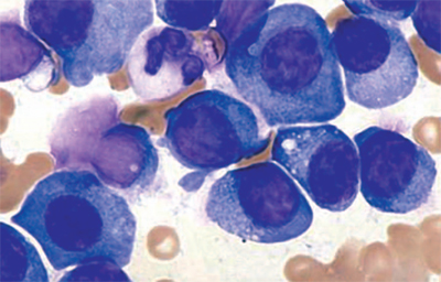 Striscio di sangue midollare che mostra numerose plasmacellule