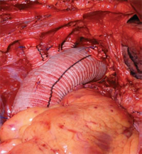 particolare cardiaco durante un intervento