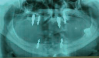 Radiografia ortopanoramica