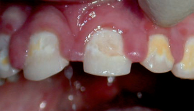 Fig. 1 Erosioni dentali in paziente affetto da Reflusso Gastro-Esofageo
