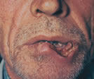 Carcinoma in situ del labbro inferiore