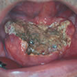 Carcinoma in situ del pavimento orale