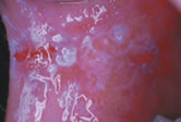 Lichen planus atrofico-erosiva mucosa geniena/commessura labiale